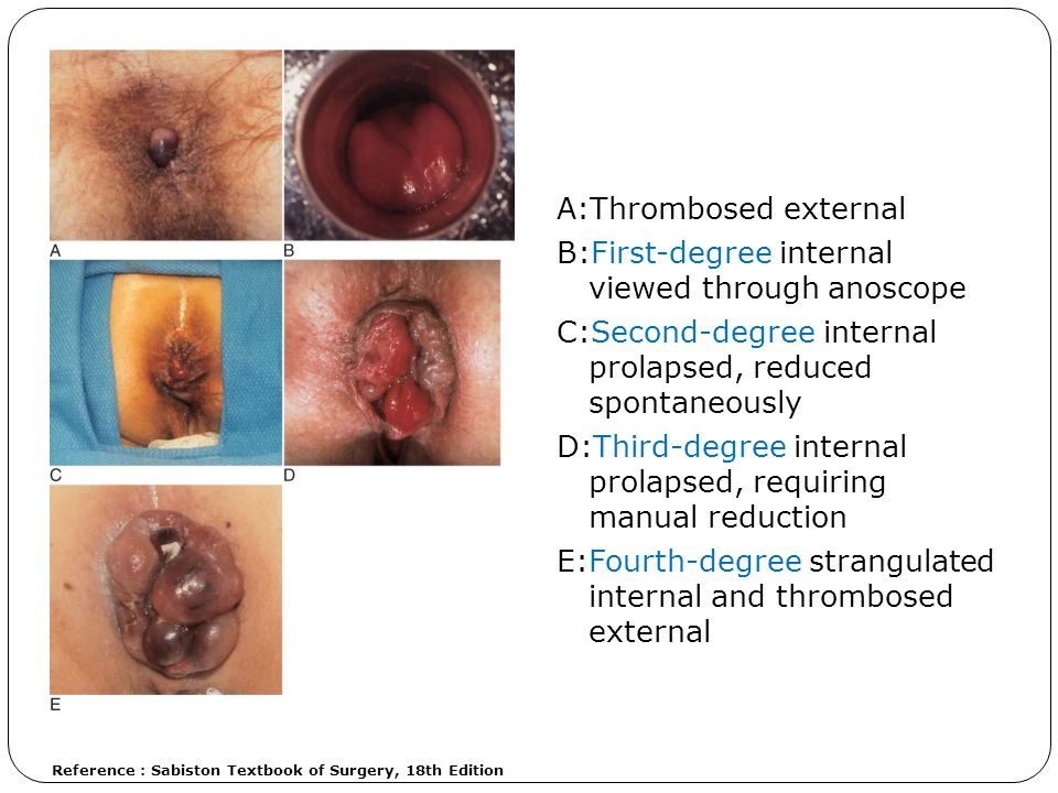 external hemorrhoid stages