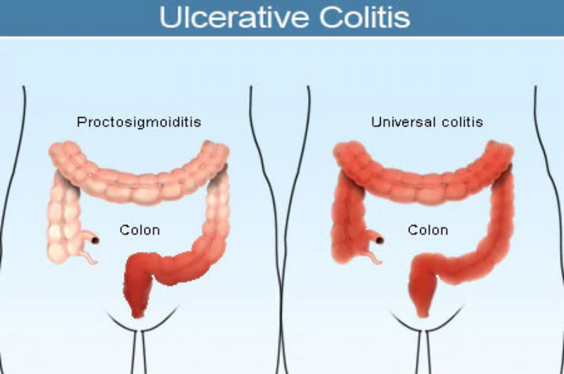 Proctosigmoiditis?, Ulcerative Colitis